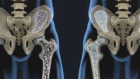 Diagnosis and Management of Osteoporosis